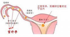 什么是宫外孕