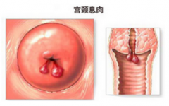 治疗宫颈息肉的医院