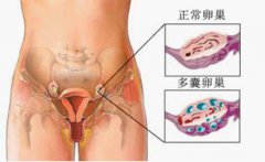 <b>多囊卵巢的危害</b>